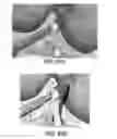 Fig. 49 - Apparatus and method for ligament reconstruction