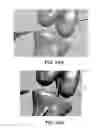 Fig. 53 - Apparatus and method for ligament reconstruction