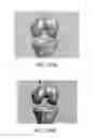 Fig. 71 - Apparatus and method for ligament reconstruction