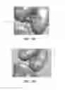 Fig. 75 - Apparatus and method for ligament reconstruction