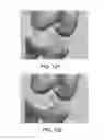 Fig. 76 - Apparatus and method for ligament reconstruction