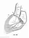 Fig. 08 - Everting heart valve