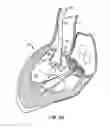 Fig. 09 - Everting heart valve