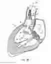 Fig. 10 - Everting heart valve