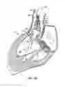 Fig. 11 - Everting heart valve