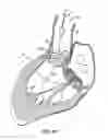 Fig. 13 - Everting heart valve