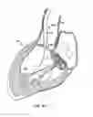 Fig. 14 - Everting heart valve