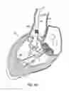 Fig. 15 - Everting heart valve