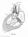 Fig. 16 - Everting heart valve