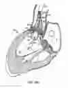 Fig. 17 - Everting heart valve