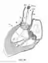 Fig. 19 - Everting heart valve