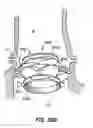 Fig. 49 - Everting heart valve