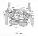 Fig. 50 - Everting heart valve