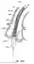 Fig. 55 - Everting heart valve