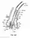 Fig. 60 - Everting heart valve