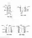 Fig. 64 - Everting heart valve