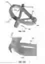 Fig. 31 - Systems and methods for delivery of annuloplasty rings