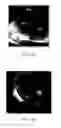 Fig. 04 - Steerable lesion excluding heart implants for congestive heart failure