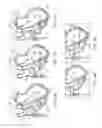 Fig. 05 - Steerable lesion excluding heart implants for congestive heart failure