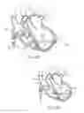 Fig. 06 - Steerable lesion excluding heart implants for congestive heart failure