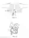Fig. 09 - Steerable lesion excluding heart implants for congestive heart failure