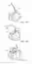 Fig. 10 - Steerable lesion excluding heart implants for congestive heart failure