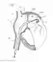 Fig. 02 - Methods, systems, and devices for resizable intra-atrial shunts