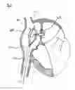 Fig. 04 - Methods, systems, and devices for resizable intra-atrial shunts