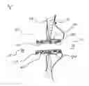 Fig. 05 - Methods, systems, and devices for resizable intra-atrial shunts
