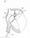 Fig. 06 - Methods, systems, and devices for resizable intra-atrial shunts