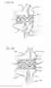Fig. 09 - Methods, systems, and devices for resizable intra-atrial shunts