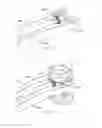 Fig. 13 - Expandable vertebral prosthesis
