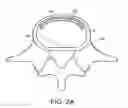 Fig. 03 - In-situ formed intervertebral fusion device and method