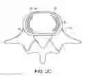 Fig. 05 - In-situ formed intervertebral fusion device and method