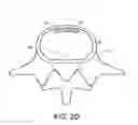 Fig. 06 - In-situ formed intervertebral fusion device and method
