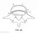 Fig. 07 - In-situ formed intervertebral fusion device and method