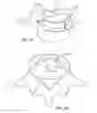 Fig. 08 - In-situ formed intervertebral fusion device and method