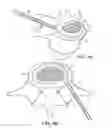 Fig. 11 - In-situ formed intervertebral fusion device and method