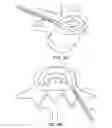 Fig. 12 - In-situ formed intervertebral fusion device and method