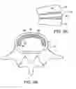 Fig. 15 - In-situ formed intervertebral fusion device and method