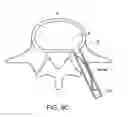 Fig. 16 - In-situ formed intervertebral fusion device and method