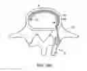 Fig. 17 - In-situ formed intervertebral fusion device and method