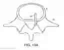 Fig. 21 - In-situ formed intervertebral fusion device and method