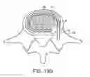 Fig. 24 - In-situ formed intervertebral fusion device and method