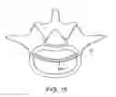 Fig. 27 - In-situ formed intervertebral fusion device and method