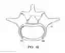 Fig. 28 - In-situ formed intervertebral fusion device and method