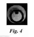 Fig. 04 - MRI visible medical device