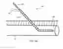 Fig. 10 - Anatomic needle system