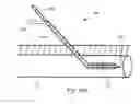 Fig. 12 - Anatomic needle system