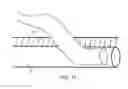 Fig. 14 - Anatomic needle system